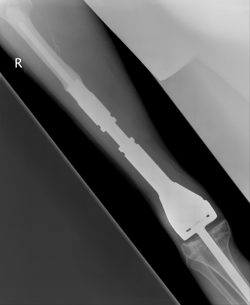 Expanded implant